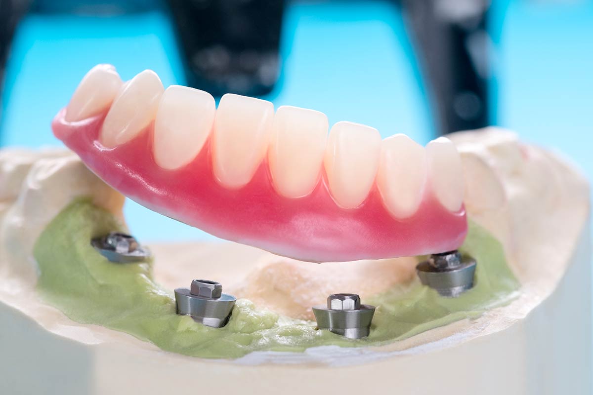implant retained dentures near me
