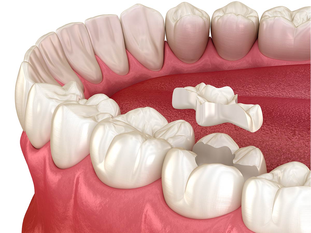 cosmetic-dentistry-porcelain-onlay